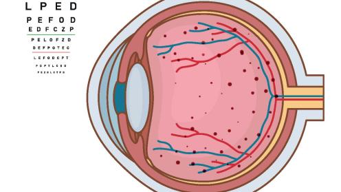 An image of an eye with diabetic retinopathy moderate stages for PCP and HCP